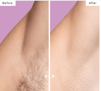 ipl hair removal 5